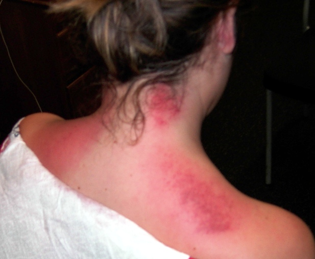 Graston treatment traps